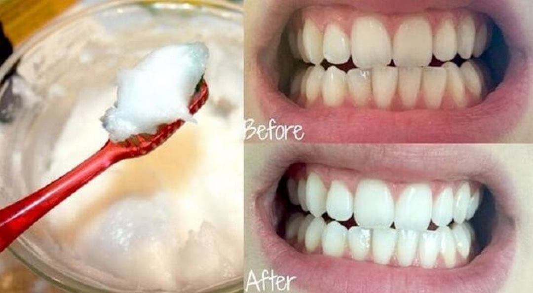 Những lưu ý khi sử dụng Baking Soda để làm trắng răng.